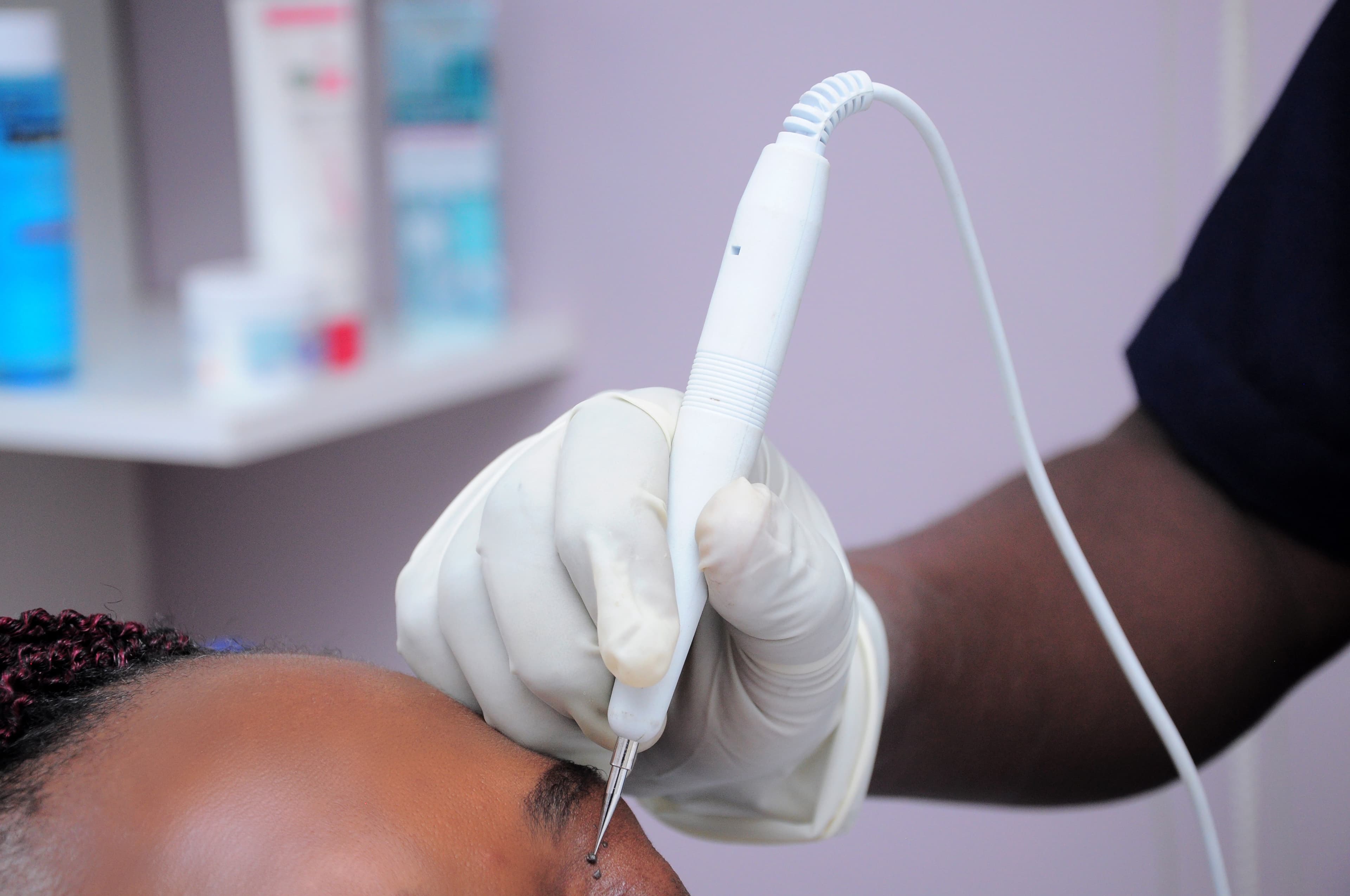 Electrocautery treatment in progress at Kampala Dermatology