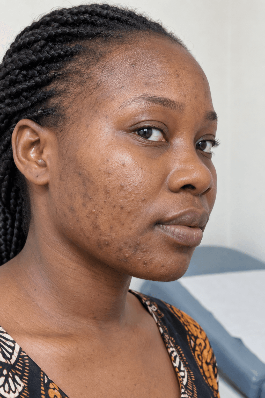 Illustrative close-up of active acne and post-inflammatory marks on melanin-rich skin