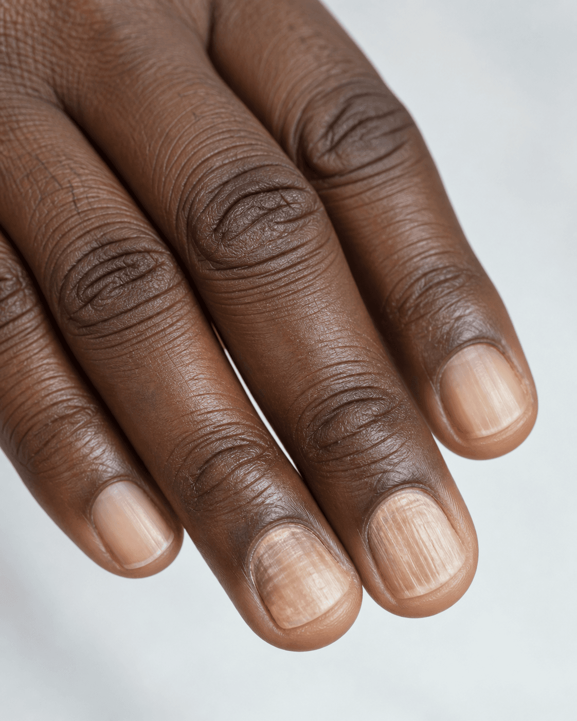 Illustrative close-up of discoloured fingernails for a nail condition guide