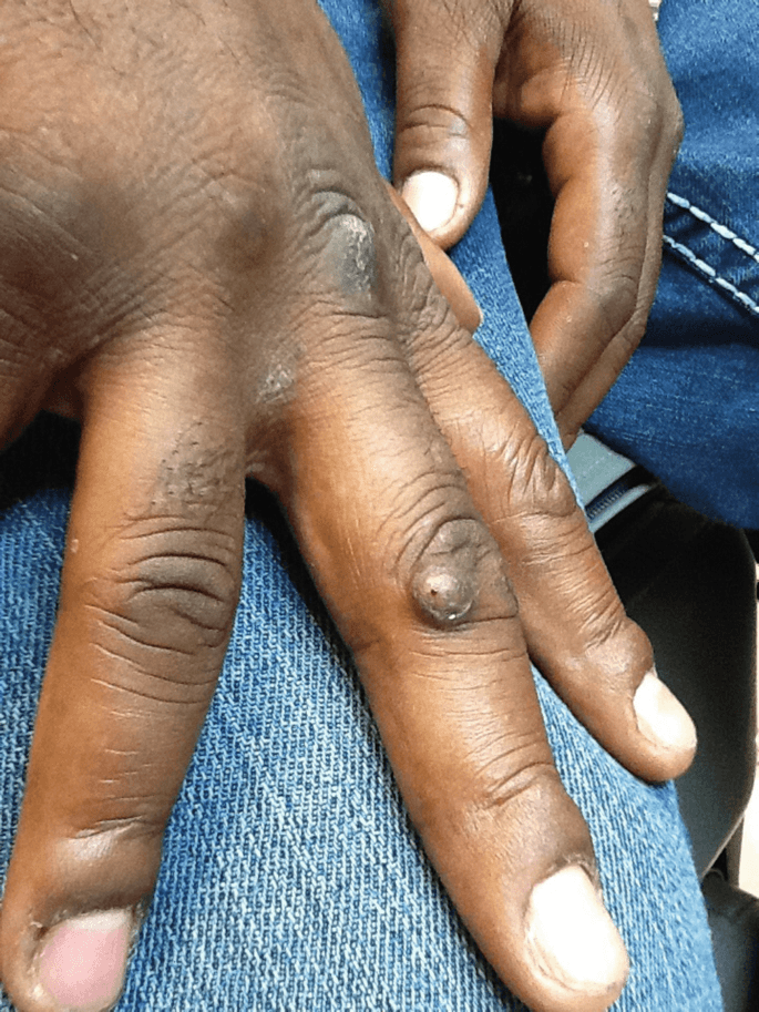 Close-up of warts on the back of a dark-skinned hand